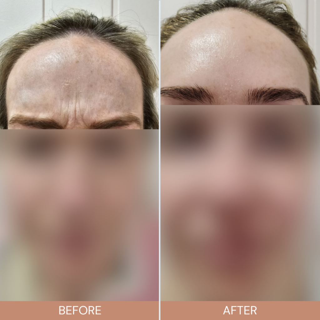 Botox Anti-Wrinkle Dermal Fillers Skin Booster Treatments Armagh